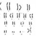 FIGURE 1: Giemsa-banded chromosomes showing the karyotype of the patient with DiGeorge syndrome (case 9).  The whole of the long arm of chromosome 22 is translocated onto the short arm of chromosome 9, resulting in monosomy of chromosome 22 (bottom arrow).   
